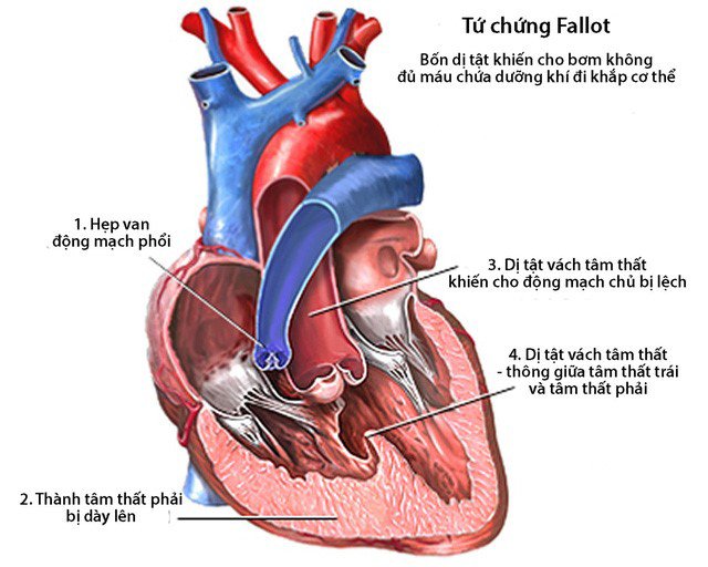 Dấu hiệu bệnh tim thường gặp cần lưu ý - 5