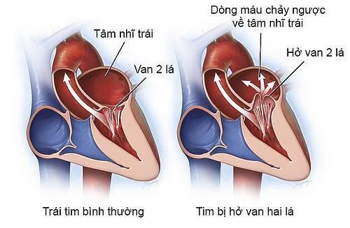 Dấu hiệu bệnh tim thường gặp cần lưu ý - 7