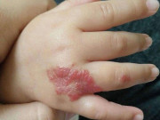 Bà bầu - 4 việc vô tình của mẹ bầu là “thủ phạm” khiến thai nhi bị vết bớt xấu xí