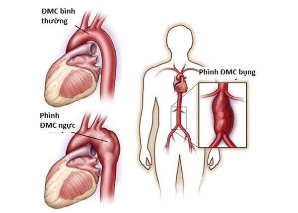 Hở van tim: Nguyên nhân, triệu chứng và cách chữa trị - 3
