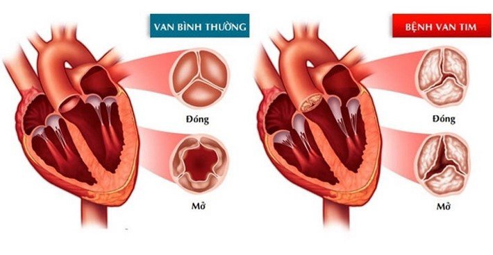 Hở van tim: Nguyên nhân, triệu chứng và cách chữa trị - 1