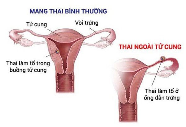 Thai ngoài tử cung và tất cả những giải đáp thường gặp - 3