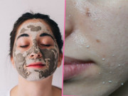 Làm đẹp - Chăm sóc da dầu mùa hè bạn nhất định phải biết 5 bí quyết này để mụn không bùng phát