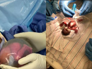 Tin tức - Ca sinh đôi hy hữu: Hai bé gái chào đời ở tuần 22, còn nguyên trong bọc ối