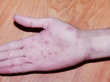 Bệnh lậu bao lâu thì khỏi? Dấu hiệu và cách điều trị bệnh
