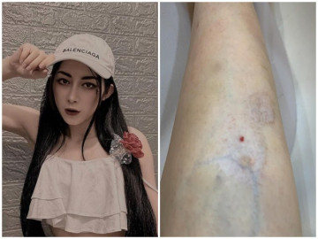 Hot girl bị teo cơ sau xóa sẹo thâm, cảnh báo điều chị em vẫn thích làm