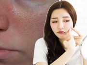 Làm đẹp - Rùng mình xem khoảnh khắc nặn mụn, bạn mới thấy mụn gây hại đến lỗ chân lông như thế nào