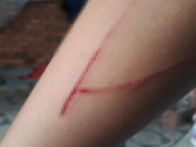 Tin tức - Vụ bé gái bị hiếp dâm ở TP.HCM: Nạn nhân bất ngờ bị 2 kẻ lạ mặt chém