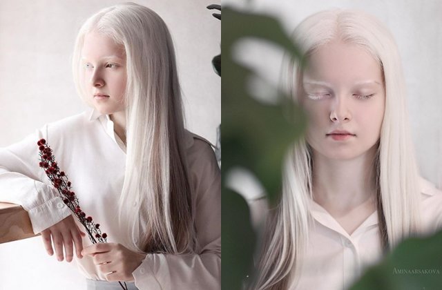 Bé gái có mắt trái xanh nước biển, mắt phải màu hổ phách, tóc 2 màu độc nhất vô nhị - 4