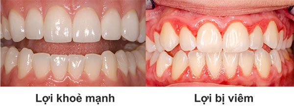 Chuyên gia mách 3 cách chữa viêm nướu tại nhà cực hiệu quả - 1