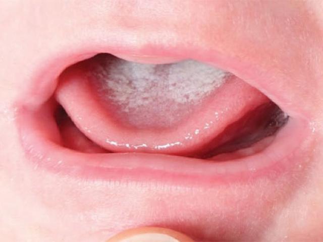 Bí quyết đánh bay tưa lưỡi ở trẻ sơ sinh