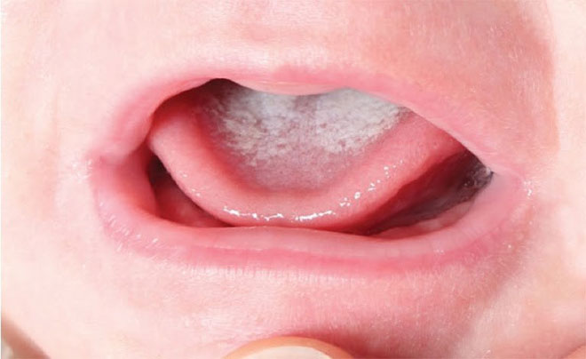 Trẻ bị tưa lưỡi cần được vệ sinh đúng cách