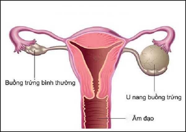 Suy giảm nội tiết tố nữ: Dấu hiệu và nguyên nhân do đâu - 5