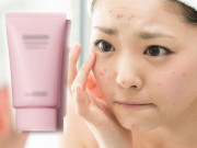 Làm đẹp - Chẳng may bị dị ứng kem chống nắng, đây là những điều các nàng nên thực hiện ngay