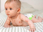 Yêu con - Nhận biết dấu hiệu bệnh sởi ở trẻ dưới 1 tuổi sau khi bị nhiễm 7-21 ngày