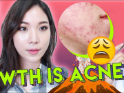 Làm đẹp - Beauty blogger Hàn chia sẻ nên và không nên ăn gì cho da mụn, nàng lưu ngay vào thực hiện
