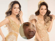 Giải trí - Hồng Ngọc đăng ảnh vết bỏng 2/3 mặt sau vụ nổ, ai cũng xót xa không dám nhìn