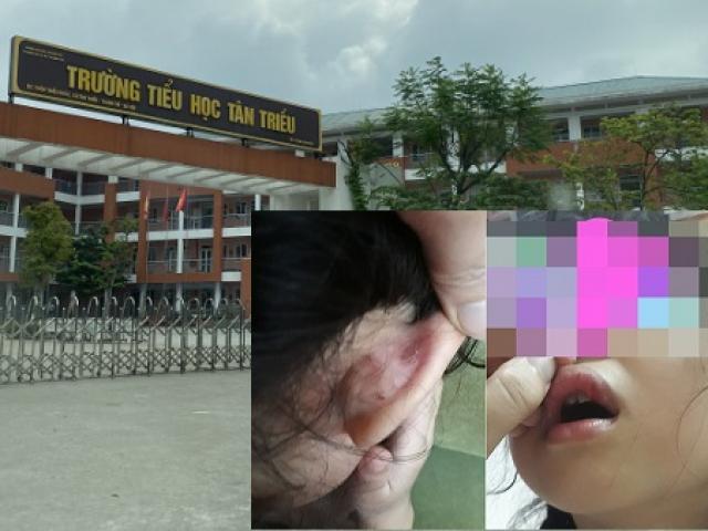 Phụ huynh tố cô giáo đánh con gái giập môi: Cô giáo nói con tôi tự cạy môi chảy máu