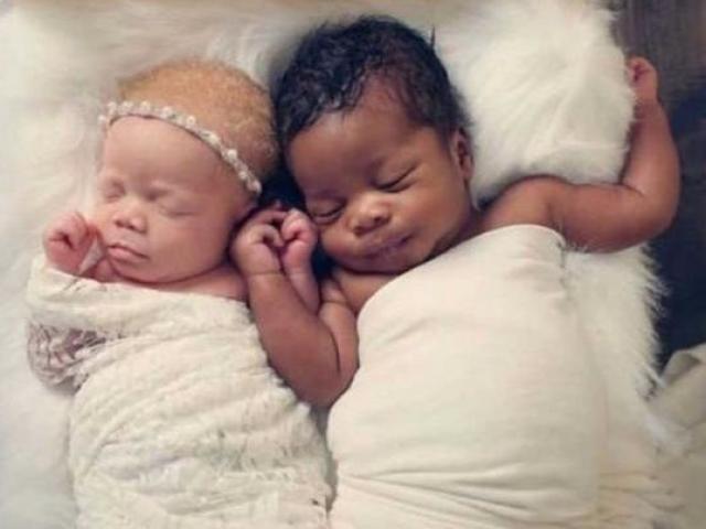 Cuộc sống sau 4 năm của cặp song sinh 1 đen, 1 trắng do bị đột biến gen