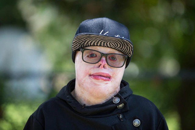 Cậu bé từng bị bỏng 95% cơ thể, trải qua 87 cuộc phẫu thuật đau đớn giờ ra sao? - 1