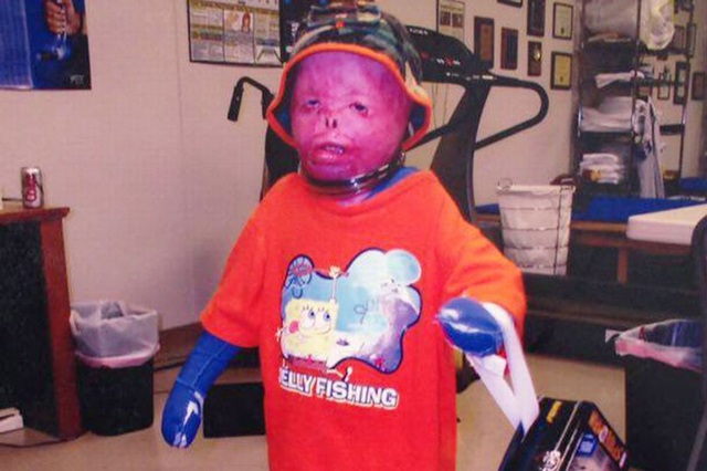 Cậu bé từng bị bỏng 95% cơ thể, trải qua 87 cuộc phẫu thuật đau đớn giờ ra sao? - 4