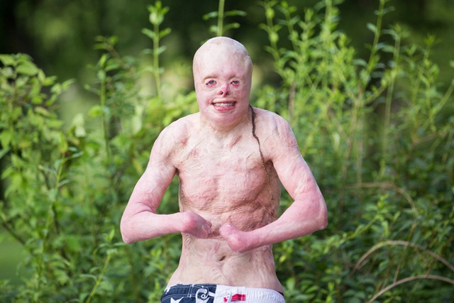 Cậu bé từng bị bỏng 95% cơ thể, trải qua 87 cuộc phẫu thuật đau đớn giờ ra sao? - 5