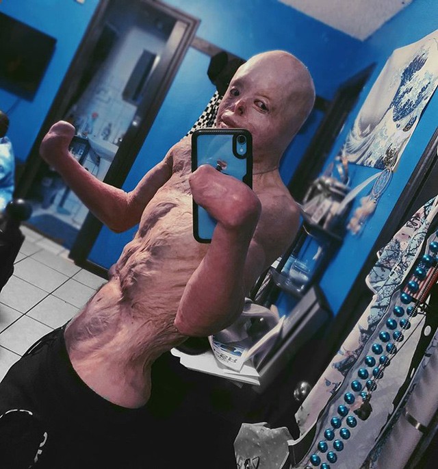 Cậu bé từng bị bỏng 95% cơ thể, trải qua 87 cuộc phẫu thuật đau đớn giờ ra sao? - 6