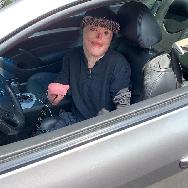 Cậu bé từng bị bỏng 95% cơ thể, trải qua 87 cuộc phẫu thuật đau đớn giờ ra sao? - 7