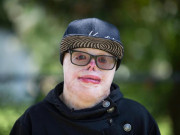 Tin tức - Cậu bé từng bị bỏng 95% cơ thể, trải qua 87 cuộc phẫu thuật đau đớn giờ ra sao?