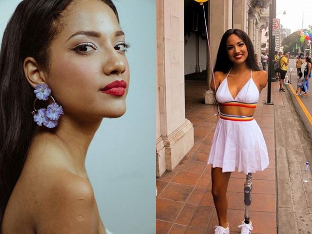 Cô gái xinh đẹp bị điện giật mất 3 chi, sống nhờ một chân duy nhất giờ ra sao?