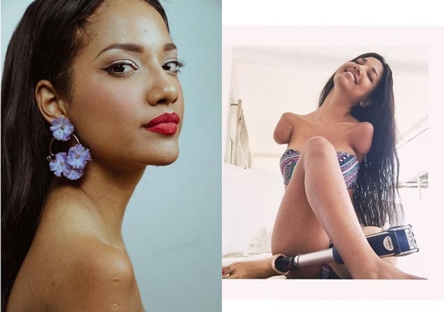 Cô gái xinh đẹp bị điện giật mất 3 chi, sống nhờ một chân duy nhất giờ ra sao? - 1