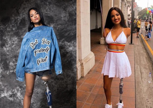 Cô gái xinh đẹp bị điện giật mất 3 chi, sống nhờ một chân duy nhất giờ ra sao? - 2