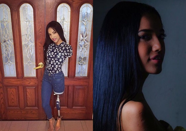 Cô gái xinh đẹp bị điện giật mất 3 chi, sống nhờ một chân duy nhất giờ ra sao? - 4