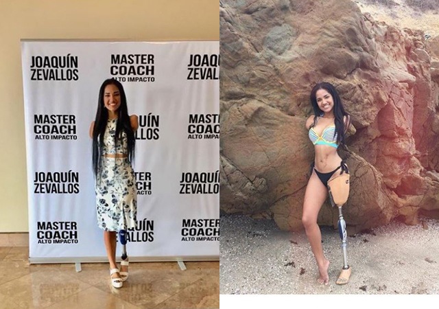 Cô gái xinh đẹp bị điện giật mất 3 chi, sống nhờ một chân duy nhất giờ ra sao? - 5