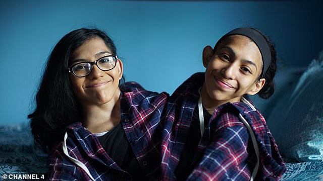 Tưởng chỉ sống được 3 ngày, 18 năm sau cặp chị em song sinh dính liền tạo nên kỳ tích - 2