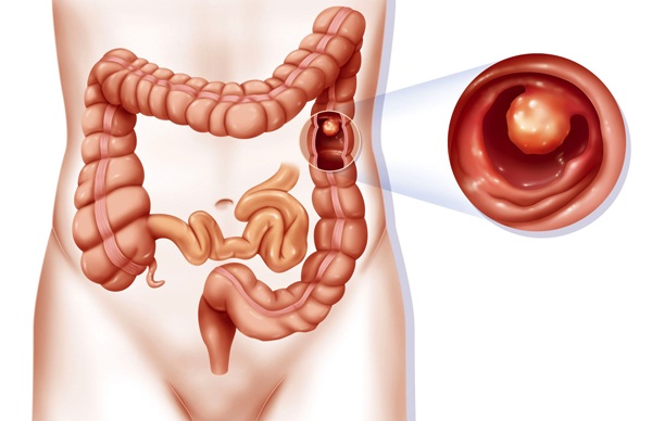 Đưa con trai đau bụng đi khám, gia đình tá hỏa khi bác sĩ nói chỉ còn nửa năm - 2