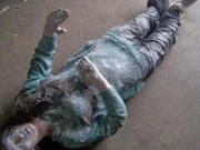 Sức khỏe - Cô gái đóng băng 6 tiếng, ngỡ đã chết nhưng bất ngờ sống lại khiến giới y học đau đầu