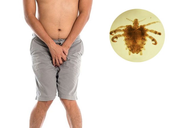 Bác sĩ dùng nhíp gắp ra 15 con rận từ mông bệnh nhân, biết lý do ngượng ngùng khó tả - 1