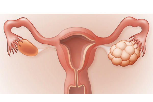 Người mắc buồng trứng có nhiều nang nhỏ nên ăn gì? - 1