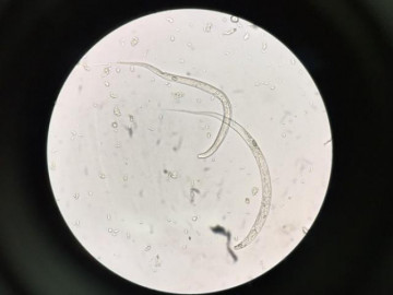 Hoảng hồn phát hiện 5 con giun lạ chưa từng có ở Việt Nam trong tay, chân bệnh nhân