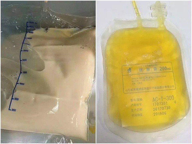 Ăn thức ăn nhanh quá nhiều, huyết tương của chàng trai trông như trà sữa