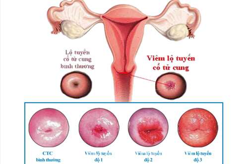 Bệnh phụ khoa của phụ nữ là gì? Những loại bệnh phụ khoa thường gặp - 5