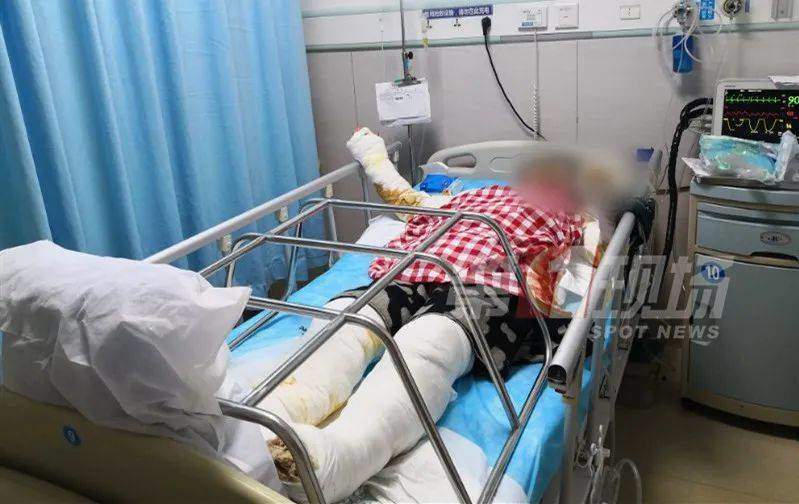 Nấu ăn tại nhà mà không đóng cửa sổ, người phụ nữ bị sét đánh bỏng cả người và mặt - 1