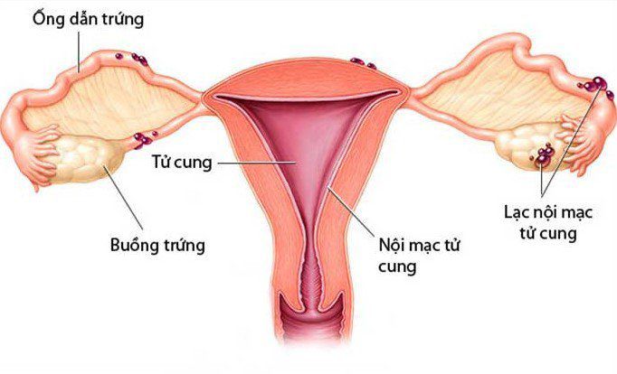 U lạc nội mạc tử cung: Triệu chứng, cách điều trị và những biến chứng - 1