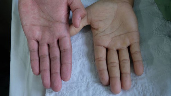 7 dấu hiệu cảnh báo cơ thể đang thiếu máu ít ai để ý, cần bổ sung chất sắt ngay - 1
