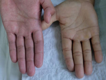 7 dấu hiệu cảnh báo cơ thể đang thiếu máu ít ai để ý, cần bổ sung chất sắt ngay