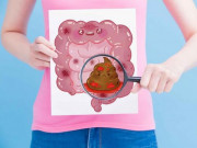 Sức khỏe - Đi vệ sinh có 3 dấu hiệu này, coi chừng ung thư ruột "gõ cửa"