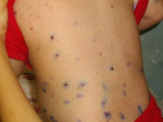 Bị thủy đậu nên ăn gì để không gặp những biến chứng nguy hiểm?