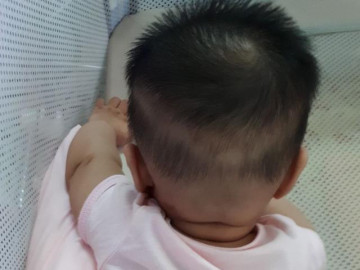 Trẻ rụng tóc vành khăn không phải do thiếu can xi, bác sĩ lý giải nguyên nhân bất ngờ