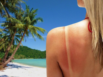 Thỏa sức vui hè với top 5 cách chăm sóc da bị cháy nắng hiệu quả ngay tại nhà